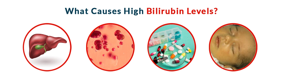 What Causes High Bilirubin Levels